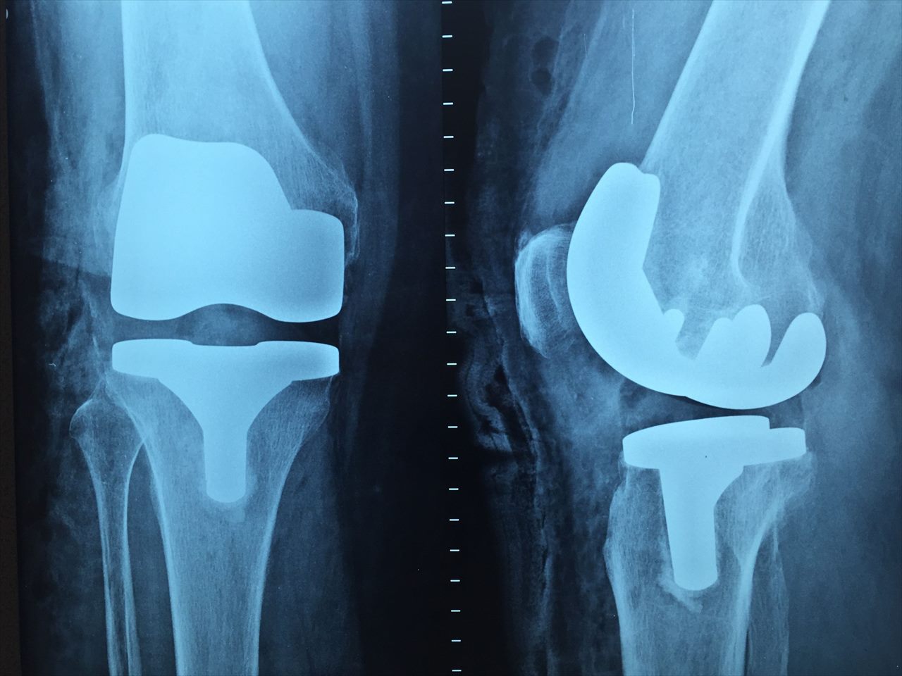 Radiografia de joelho em avaliação médica
